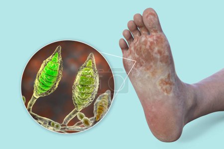 Téléchargez les photos : Le pied avec mycose, et vue rapprochée des champignons Microsporum canis qui causent le pied d'athlète, illustration 3D - en image libre de droit