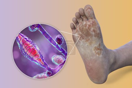 Photo for The foot with mycosis, and close-up view of fungi Microsporum canis that cause Athlete's foot, 3D illustration - Royalty Free Image