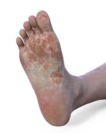 Photo for The foot of a middle-age female person with mycosis, bottom view, 3d illustration - Royalty Free Image