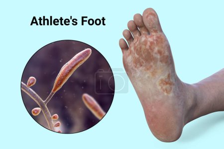 Téléchargez les photos : Le pied avec mycose, et vue rapprochée des champignons Trichophyton rubrum qui causent le pied d'athlète, illustration 3D - en image libre de droit