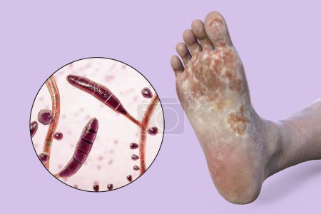 Foto de El pie con micosis, y vista de cerca de los hongos Trichophyton rubrum que causan pie de atleta, ilustración 3D - Imagen libre de derechos
