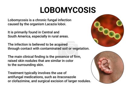 Foto de Lobomicosis, una enfermedad crónica de la piel causada por hongos microscópicos Lacazia loboi y caracterizada por lesiones nodulares y queloidales que afectan principalmente a las extremidades y las orejas, ilustración 3D - Imagen libre de derechos
