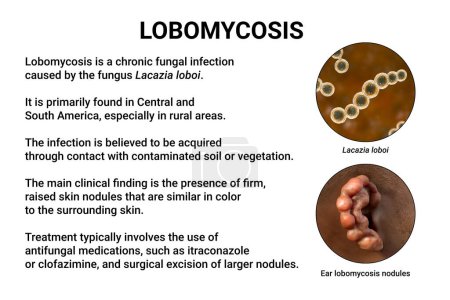 Foto de Lobomicosis, una enfermedad crónica de la piel causada por hongos microscópicos Lacazia loboi y caracterizada por lesiones nodulares y queloidales que afectan principalmente a las extremidades y las orejas, ilustración 3D - Imagen libre de derechos