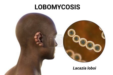 Téléchargez les photos : Lobomycose, une maladie chronique de la peau causée par des champignons microscopiques Lacazia loboi et caractérisée par des lésions nodulaires et keloïdales affectant principalement les membres et les oreilles, illustration 3D photoréaliste - en image libre de droit