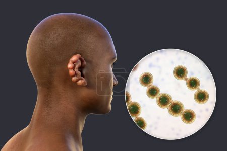 Foto de Lobomicosis, una enfermedad crónica de la piel causada por hongos microscópicos Lacazia loboi y caracterizada por lesiones nodulares y queloidales que afectan principalmente a las extremidades y las orejas, ilustración fotorrealista 3D - Imagen libre de derechos