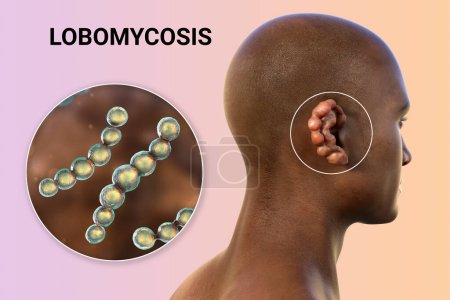 Téléchargez les photos : Lobomycose, une maladie chronique de la peau causée par des champignons microscopiques Lacazia loboi et caractérisée par des lésions nodulaires et keloïdales affectant principalement les membres et les oreilles, illustration 3D photoréaliste - en image libre de droit