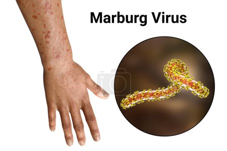 Photo for A skin rash on the arm of a patient with Marburg hemorrhagic fever and close-up view of the Marburg virus particle, 3D illustration - Royalty Free Image