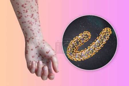 Photo for A skin rash on the arm of a patient with Marburg hemorrhagic fever and close-up view of the Marburg virus particle, 3D illustration - Royalty Free Image