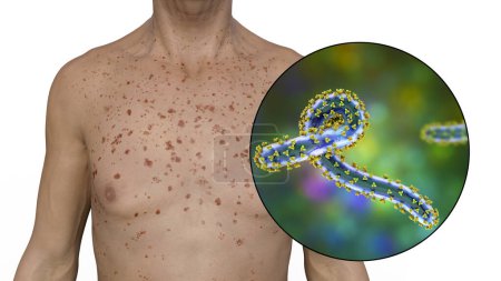 Photo for A skin rash on the chest of a patient with Marburg hemorrhagic fever and close-up view of the Marburg virus particle, 3D illustration - Royalty Free Image