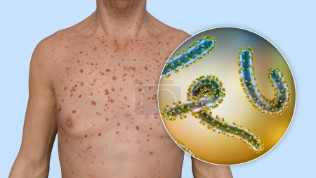 Photo for A skin rash on the chest of a patient with Marburg hemorrhagic fever and close-up view of the Marburg virus particle, 3D illustration - Royalty Free Image