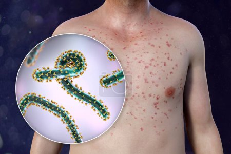 A skin rash on the chest of a patient with Marburg hemorrhagic fever and close-up view of the Marburg virus particle, 3D illustration