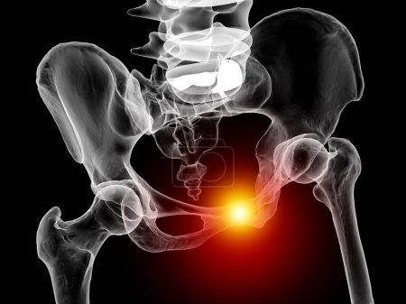 Foto de Disfunción de la sínfisis pubis, ilustración 3D que muestra huesos pélvicos y resaltado en sínfisis de pubis rojos - Imagen libre de derechos