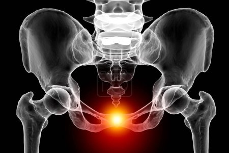 Symphyse dysfonctionnement du pubis, illustration 3D montrant les os pelviens et mis en évidence dans la symphyse du pubis rouge