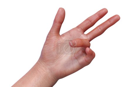 Hand einer Patientin mit Dupuytren-Kontraktur, die dazu führt, dass sich die Finger zur Handfläche hin verbiegen, fotorealistische 3D-Illustration