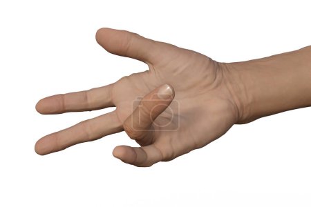 Foto de Mano de un paciente masculino con contractura de Dupuytren, una condición que hace que los dedos se doblen hacia la palma, ilustración fotorrealista 3D - Imagen libre de derechos