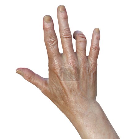 Foto de Mano de una paciente femenina con contractura de Dupuytren, una condición que hace que los dedos se doblen hacia la palma de la mano, ilustración fotorrealista 3D - Imagen libre de derechos