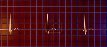 Téléchargez les photos : Électrocardiogramme ECG affichant un rythme conjonctionnel, qui se produit lorsque les signaux électriques dans le cœur proviennent de la jonction auriculo-ventriculaire au lieu du nœud sinoatrial, illustration 3D - en image libre de droit
