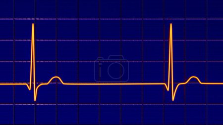 Photo for Electrocardiogram ECG displaying a junctional rhythm, which occurs when the electrical signals in the heart originate from the atrioventricular junction instead of the sinoatrial node, 3D illustration - Royalty Free Image