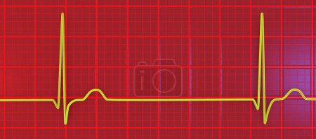 Foto de Electrocardiograma ECG que muestra un ritmo de unión, que ocurre cuando las señales eléctricas en el corazón se originan en la unión auriculoventricular en lugar del nodo sinoauricular, ilustración 3D - Imagen libre de derechos