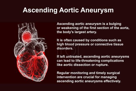 Téléchargez les photos : Un cœur humain avec un anévrisme aortique ascendant, illustration 3D mettant l'accent sur la dilatation et les risques potentiels pour la santé associés à la condition - en image libre de droit