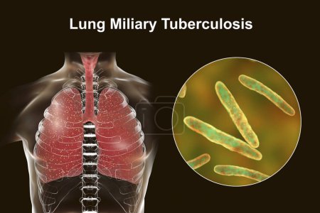 Téléchargez les photos : Une illustration photoréaliste 3D détaillée montrant les poumons humains atteints de tuberculose miliaire, avec une vue rapprochée de la bactérie Mycobacterium tuberculosis responsable de l'infection - en image libre de droit