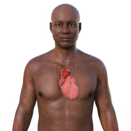 Foto de Una ilustración fotorrealista en 3D de la mitad superior de un hombre africano con piel transparente, revelando un aneurisma aórtico ascendente - Imagen libre de derechos