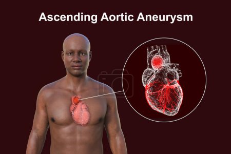 Illustration photoréaliste en 3D de la moitié supérieure d'un Africain à la peau transparente, révélant un anévrisme aortique ascendant
