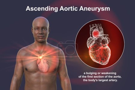 Téléchargez les photos : Illustration photoréaliste en 3D de la moitié supérieure d'un Africain à la peau transparente, révélant un anévrisme aortique ascendant - en image libre de droit