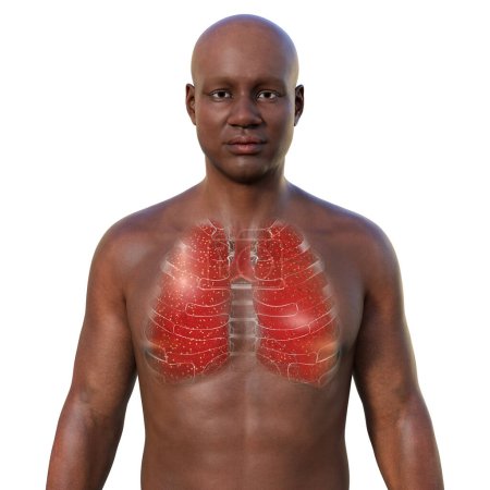 Foto de Una ilustración fotorrealista en 3D que retrata a un hombre africano con piel transparente, mostrando sus pulmones afectados por la tuberculosis miliar, enfatizando la condición médica y la representación étnica. - Imagen libre de derechos