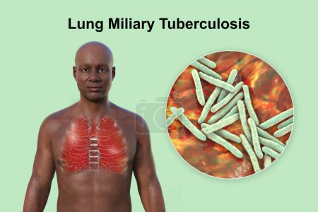 Photo for A 3D photorealistic illustration of the upper half of a man with transparent skin, showcasing the lungs affected by miliary tuberculosis and close-up view of Mycobacterium tuberculosis bacteria - Royalty Free Image