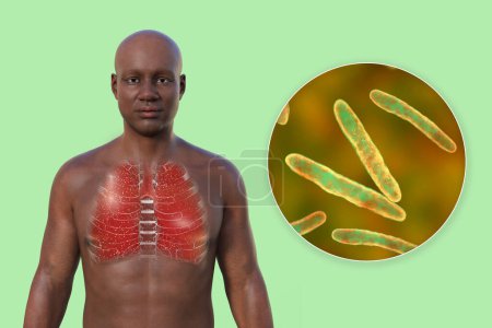 Photo for A 3D photorealistic illustration of the upper half of a man with transparent skin, showcasing the lungs affected by miliary tuberculosis and close-up view of Mycobacterium tuberculosis bacteria - Royalty Free Image