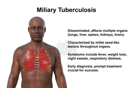 Téléchargez les photos : Illustration photoréaliste 3D de la moitié supérieure d'un homme à la peau transparente, mettant en valeur les poumons atteints de tuberculose miliaire - en image libre de droit