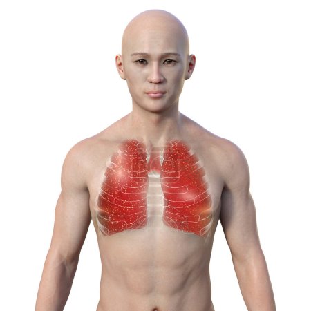 Téléchargez les photos : Illustration photoréaliste en 3D représentant un homme asiatique à la peau transparente, montrant ses poumons atteints de tuberculose miliaire, mettant l'accent sur la condition médicale et la représentation ethnique - en image libre de droit