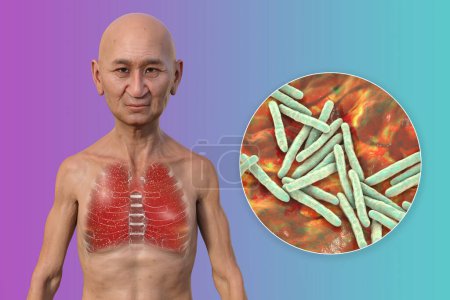 Téléchargez les photos : Illustration photoréaliste 3D de la moitié supérieure d'un homme à peau transparente, montrant les poumons affectés par la tuberculose miliaire et une vue rapprochée de la bactérie Mycobacterium tuberculosis - en image libre de droit