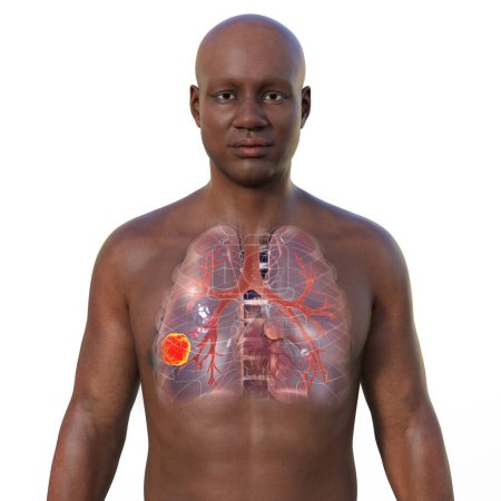 Foto de Una ilustración fotorrealista en 3D de la mitad superior de un hombre africano con piel transparente, que revela la presencia de cáncer de pulmón. - Imagen libre de derechos
