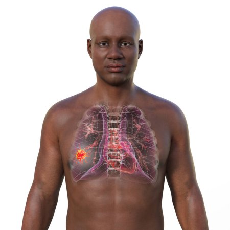 Foto de Una ilustración fotorrealista en 3D de la mitad superior de un hombre africano con piel transparente, que revela la presencia de cáncer de pulmón. - Imagen libre de derechos