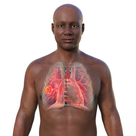 Photo for A 3D photorealistic illustration of the upper half part of an African man with transparent skin, revealing a lung mucormycosis lesion - Royalty Free Image