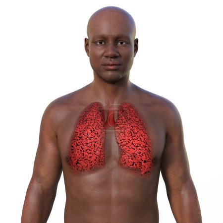 Foto de Una ilustración fotorrealista en 3D de la mitad superior de un hombre africano con piel transparente, revelando la condición de los pulmones del fumador - Imagen libre de derechos