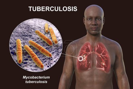 Foto de Una ilustración fotorrealista 3D de la mitad superior de un hombre con la piel transparente, mostrando los pulmones afectados por la tuberculosis cavernosa, y vista de cerca de la bacteria Mycobacterium tuberculosis - Imagen libre de derechos