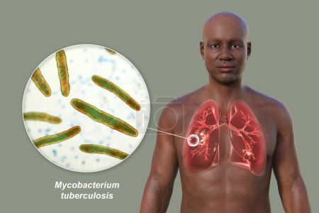 Téléchargez les photos : Illustration photoréaliste en 3D de la moitié supérieure d'un homme à peau transparente, montrant les poumons atteints de tuberculose caverneuse et vue rapprochée de la bactérie Mycobacterium tuberculosis - en image libre de droit