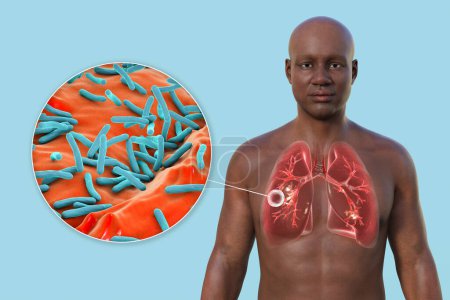 Téléchargez les photos : Illustration photoréaliste en 3D de la moitié supérieure d'un homme à peau transparente, montrant les poumons atteints de tuberculose caverneuse et vue rapprochée de la bactérie Mycobacterium tuberculosis - en image libre de droit