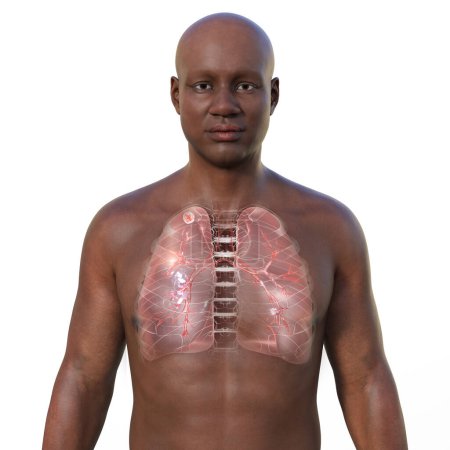 Foto de Una ilustración fotorrealista en 3D que muestra la mitad superior de un hombre africano con piel transparente, revelando los pulmones afectados por tuberculosis secundaria con nódulo apical - Imagen libre de derechos