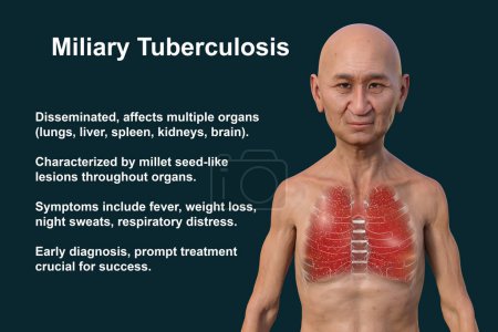 Photo for A 3D photorealistic illustration of the upper half of a man with transparent skin, showcasing the lungs affected by miliary tuberculosis - Royalty Free Image