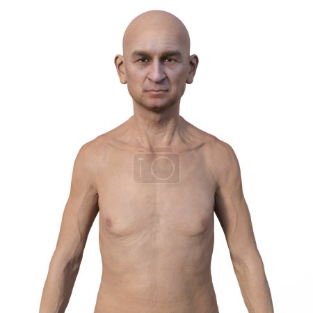 Téléchargez les photos : Illustration photoréaliste en 3D représentant la moitié supérieure d'un homme européen âgé, chauve et nu, montrant sa peau vieillissante et les changements anatomiques qui viennent avec l'âge - en image libre de droit