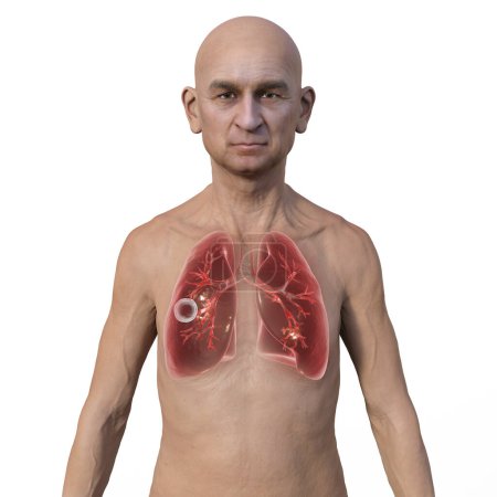 Foto de Una ilustración fotorrealista en 3D de la mitad superior de un hombre con piel transparente, mostrando los pulmones afectados por la tuberculosis cavernosa - Imagen libre de derechos