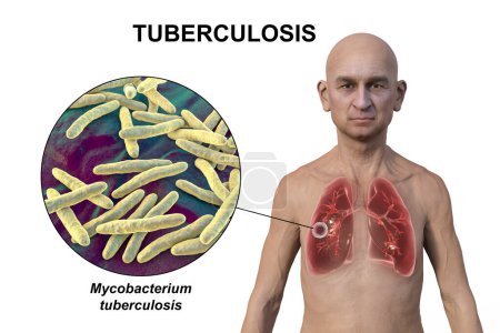 Téléchargez les photos : Illustration photoréaliste 3D de la moitié supérieure d'un homme à peau transparente, montrant les poumons affectés par la tuberculose caverneuse et une vue rapprochée de la bactérie Mycobacterium tuberculosis - en image libre de droit