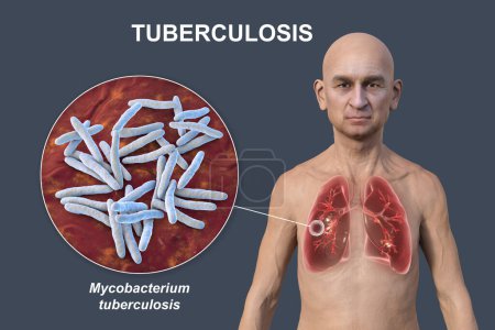 Photo for A 3D photorealistic illustration of the upper half of a man with transparent skin, showcasing the lungs affected by cavernous tuberculosis and close-up view of Mycobacterium tuberculosis bacteria - Royalty Free Image
