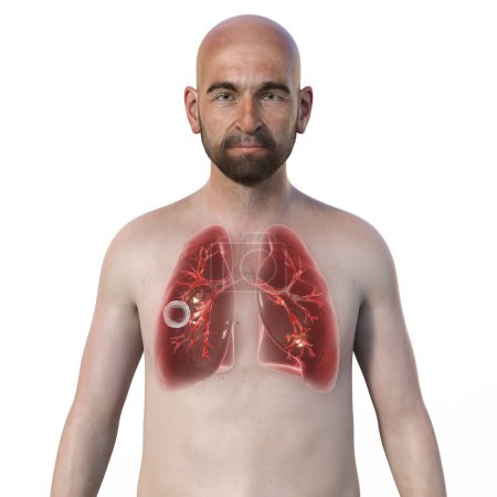 Foto de Una ilustración fotorrealista en 3D de la mitad superior de un hombre con piel transparente, mostrando los pulmones afectados por la tuberculosis cavernosa - Imagen libre de derechos