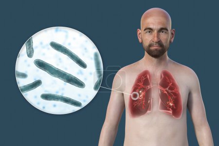 Téléchargez les photos : Illustration photoréaliste 3D de la moitié supérieure d'un homme à peau transparente, montrant les poumons affectés par la tuberculose caverneuse et une vue rapprochée de la bactérie Mycobacterium tuberculosis - en image libre de droit