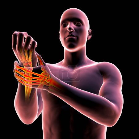 Foto de Un hombre que experimenta dolor en la muñeca, con el esqueleto resaltado para mostrar el área afectada, ilustración 3D - Imagen libre de derechos